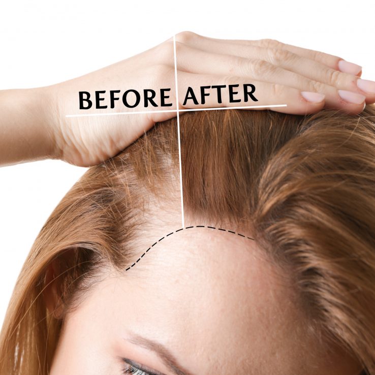 Tratament împotriva căderii părului pentru femei- frumusete-par (4)